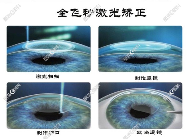 全飞秒近视手术的利与弊
