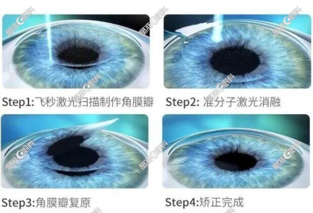 近视眼矫正做半飞秒激光手术的利与弊