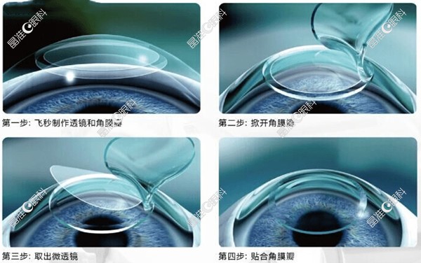 半飞秒近视手术多少度数范围内可以做