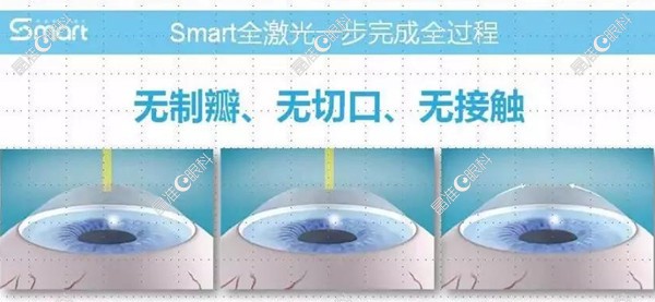 全激光近视眼手术优缺点.ji-zhun.com