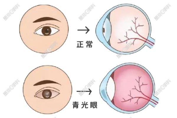 青光眼是什么原因引起的