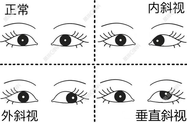 眼睛斜视的分类