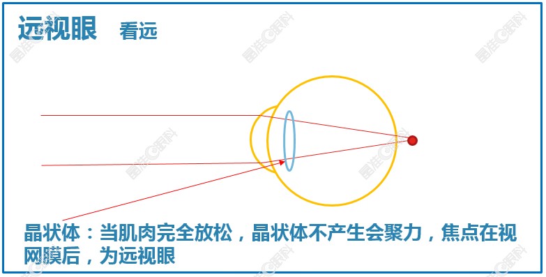 先天性远视是可以做手术矫正的www.ji-zhun.com