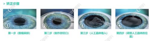 杭州茗视佳眼科晶体植入手术