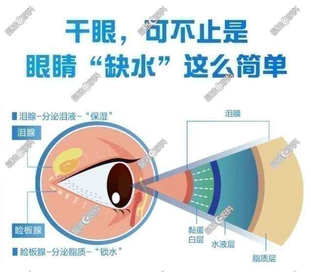 干眼症可不止缺水那么简单