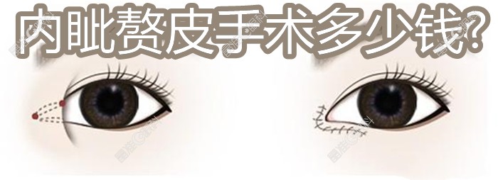 内眦赘皮手术多少钱