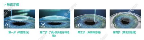 杭州茗视佳眼科全飞秒SMILE近视手术ji-zhun.com