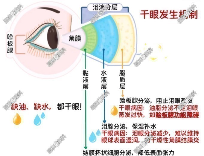 干眼症发生机制