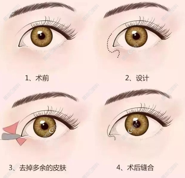 轻微内眦赘皮手术www.ji-zhun.com