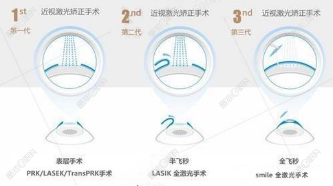 目前采用近视矫正手术的原理也可以矫正远视