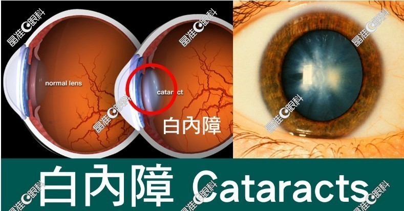 重庆千叶眼科医院郑汉医生白内障手术做的非常好