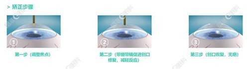 杭州茗视佳全激光手术