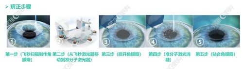 杭州茗视佳眼科半飞秒手术
