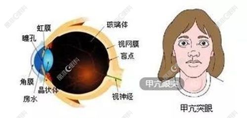 甲亢性突眼症的分级标准是什么