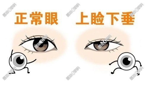 上睑下垂手术费用价格表www.8682.cc