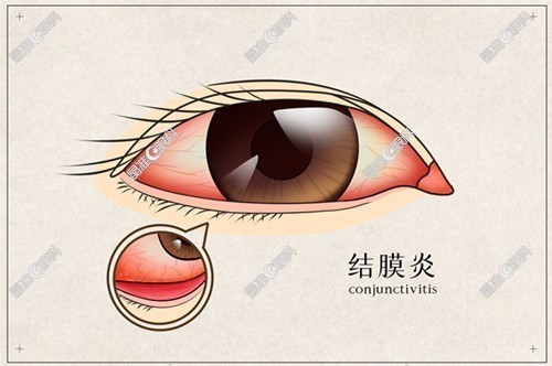 角膜炎和结膜炎的区别是在症状上