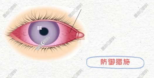 眼科炎症临床表现症状