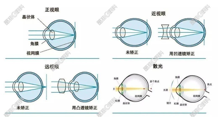 双眼屈光不正是什么意思ji-zhun.com