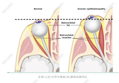 甲亢突眼症能治疗好吗