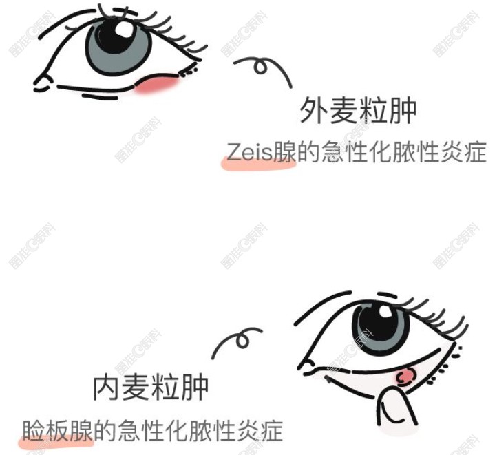 麦粒肿常见的部位