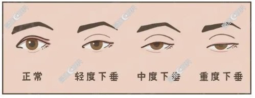 先天性上睑下垂矫正术费用