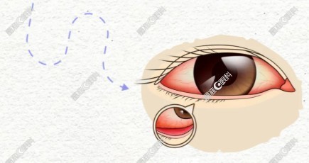 眼科炎症症状@晶准眼科