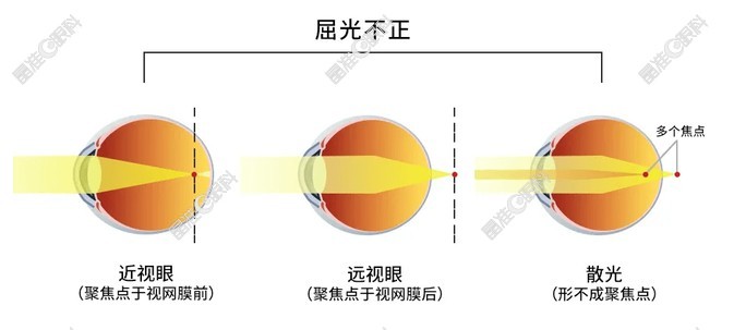 屈光不正和近视有什么区别