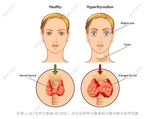 甲亢突眼六个眼征