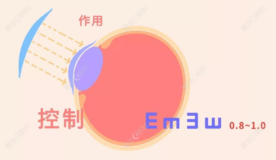 儿童萨努刚戴角膜塑形镜原理