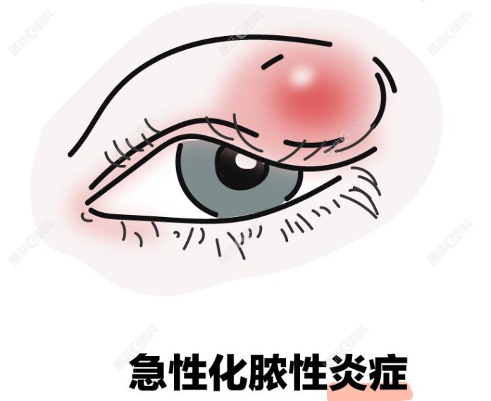 麦粒肿成熟化脓图www.ji-zhun.com