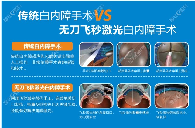 杭州爱尔眼科医院白内障手术怎么样