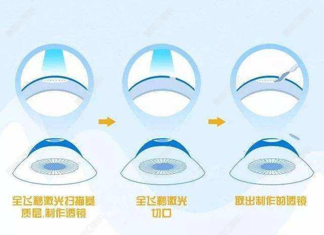 远视做全飞秒矫正手术价格不贵原理也不同www.ji-zhun.com