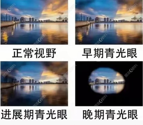 青光眼的类型与症状