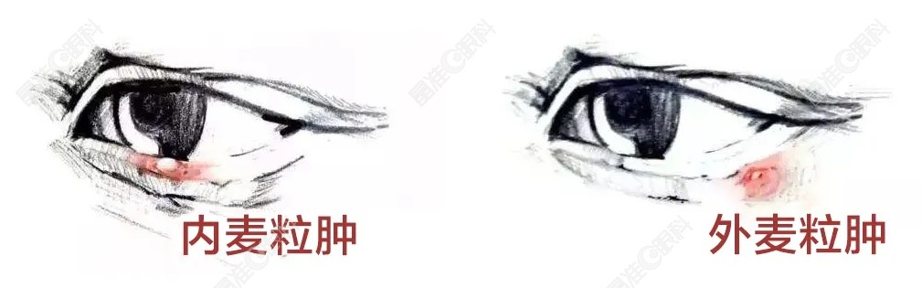 麦粒肿是什么样子的图片