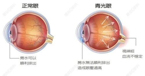 青光眼的7大征兆
