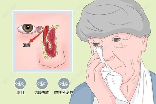 成人泪道堵塞手术怎么做