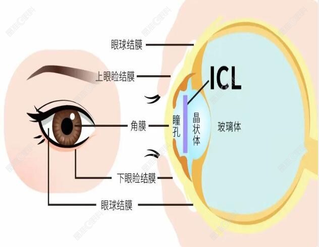 白内障近视加散光的晶体选择