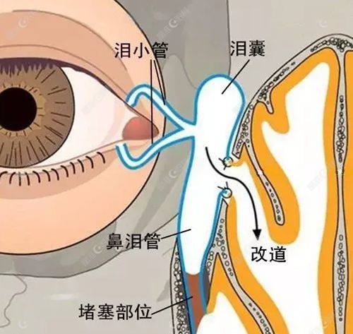 成人鼻腔泪囊吻合手术怎么做