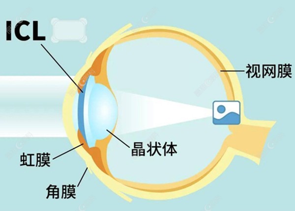 晶体植入的图www.ji-zhun.com