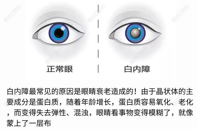 白内障的症状和表现是什么www.ji-zhun.com