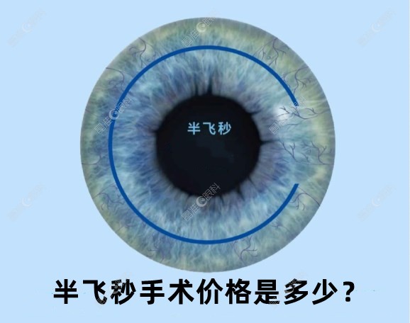 半飞秒激光手术多少钱一次ji-zhun.com