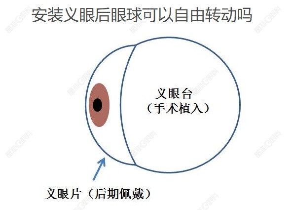 安装义眼后眼球可以自由转动吗www.ji-zhun.com