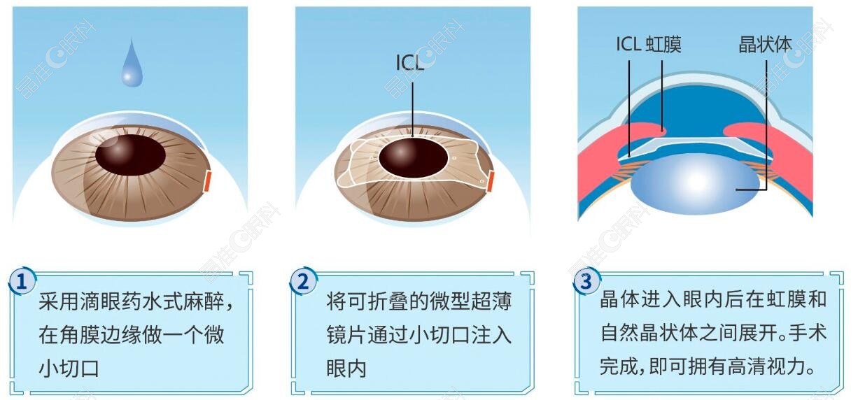 近视眼手术步骤图