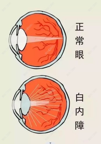 潍坊明润眼科医院杨明做白内障手术怎么样