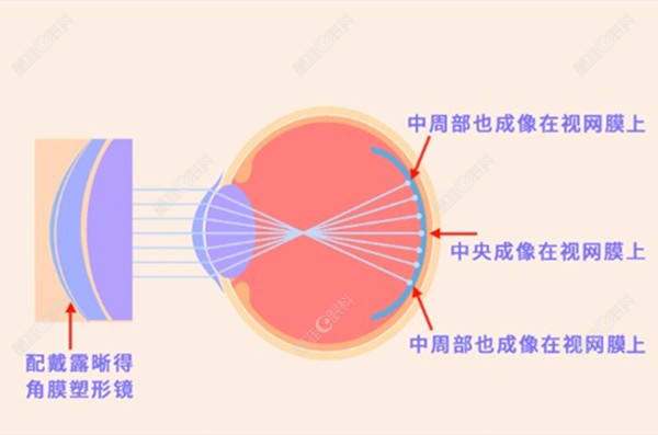 角膜塑形镜的原理www.ji-zhun.com