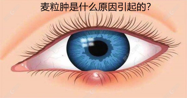 麦粒肿是什么原因引起的