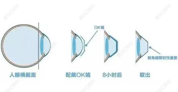 ok镜每周停戴1天可以吗