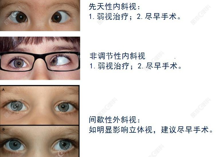 不同类型的斜视矫正方式也不同www.ji-zhun.com