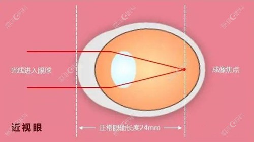 眼轴长度与近视对照表新版
