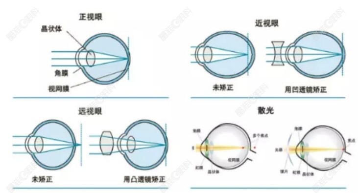 近视眼手术